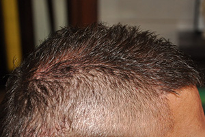 patient a hair transplant results